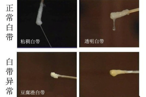 白带常规