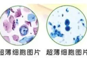 宫颈刮片