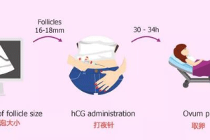 促排卵针