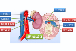 精索静脉曲张