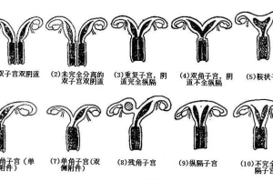 单角子宫
