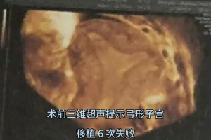 弓形子宫