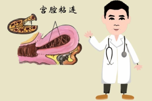 宫腔粘连