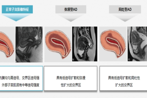 子宫腺肌症