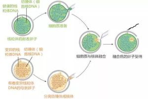 第四代试管婴儿(GVT)