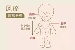 风疹病毒(RAN)