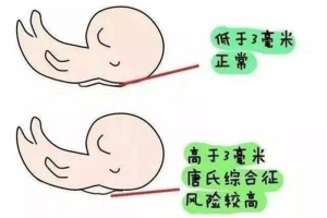 胎儿nt检查